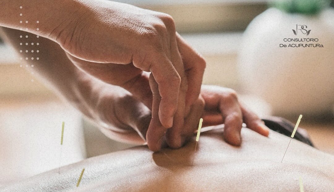 Acupuntura para tratamento de dor nas costas
